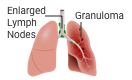 Sarcoidosis icon