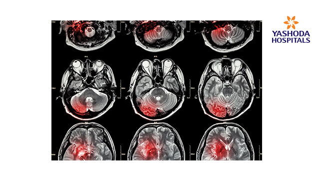 Brain stroke and treatments