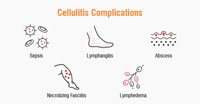 Cellulitis complications