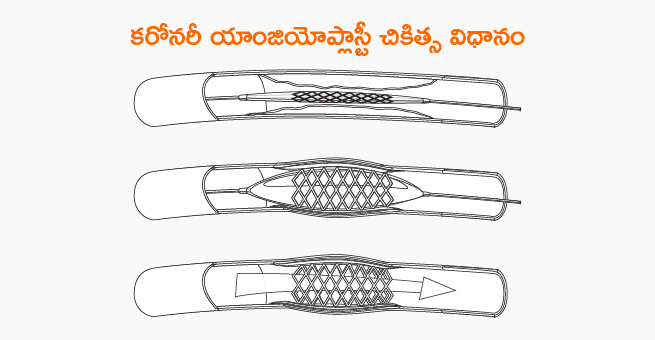 Coronary Angioplasty Types, Benefits & Precautions After Surgery_telugu