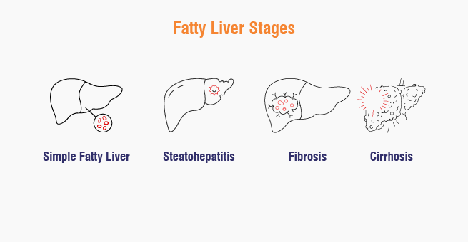 Fatty liver stages