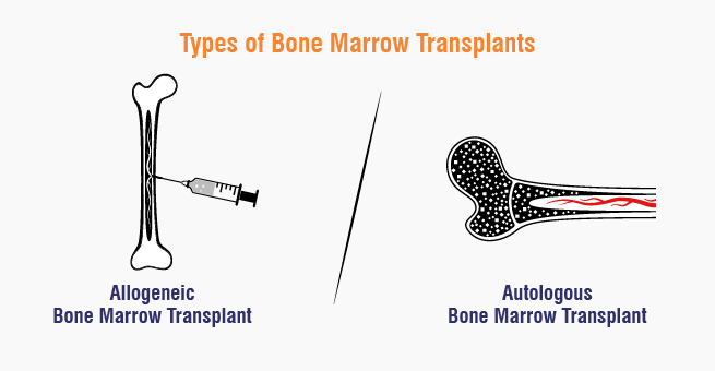 Types of Bone Marrow Transplants